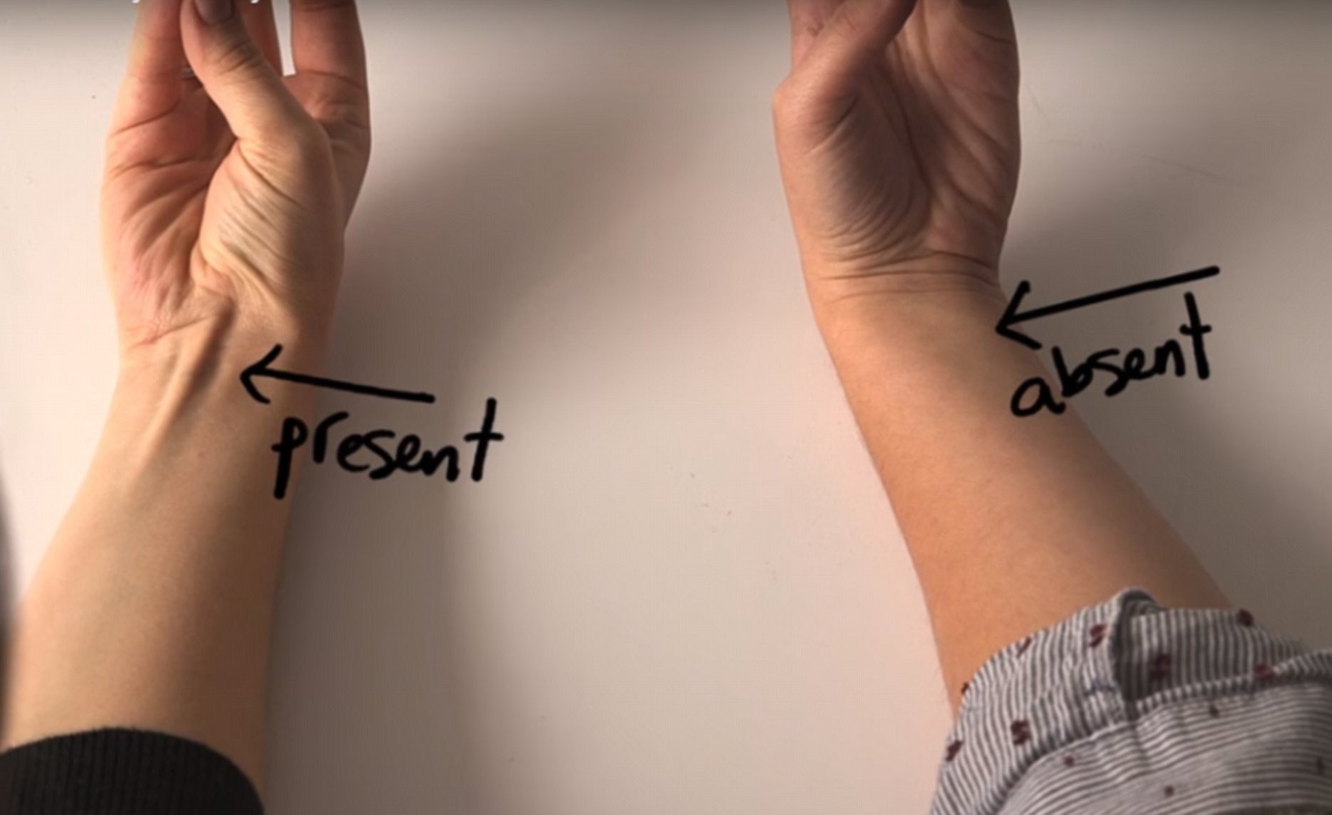 How to Tell if Evolution Has Caused You to Lose This Arm Tendon