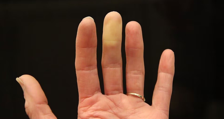 Why Your Finger Turns White in the Cold: What’s Really Happening?