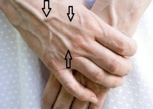 If you see someone with bulging veins, you must tell them these things