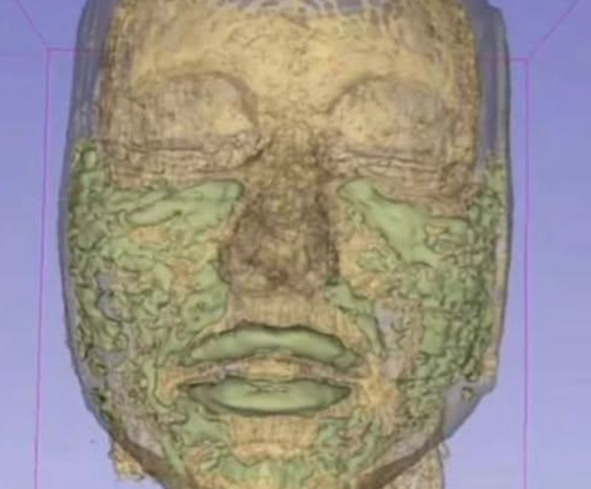 Plastic surgeon reveals damage fillers do in long term