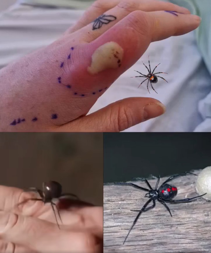 What to do if you get bit.ten by a black widow spider: A complete guide