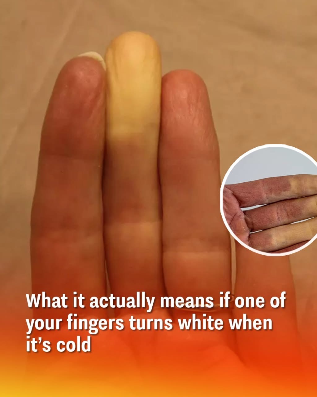What It Means If Your Fingers Turn White When It’s Cold
