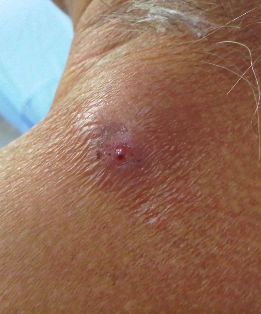 He Thought He Had Acne, But It Was Something Completely Different